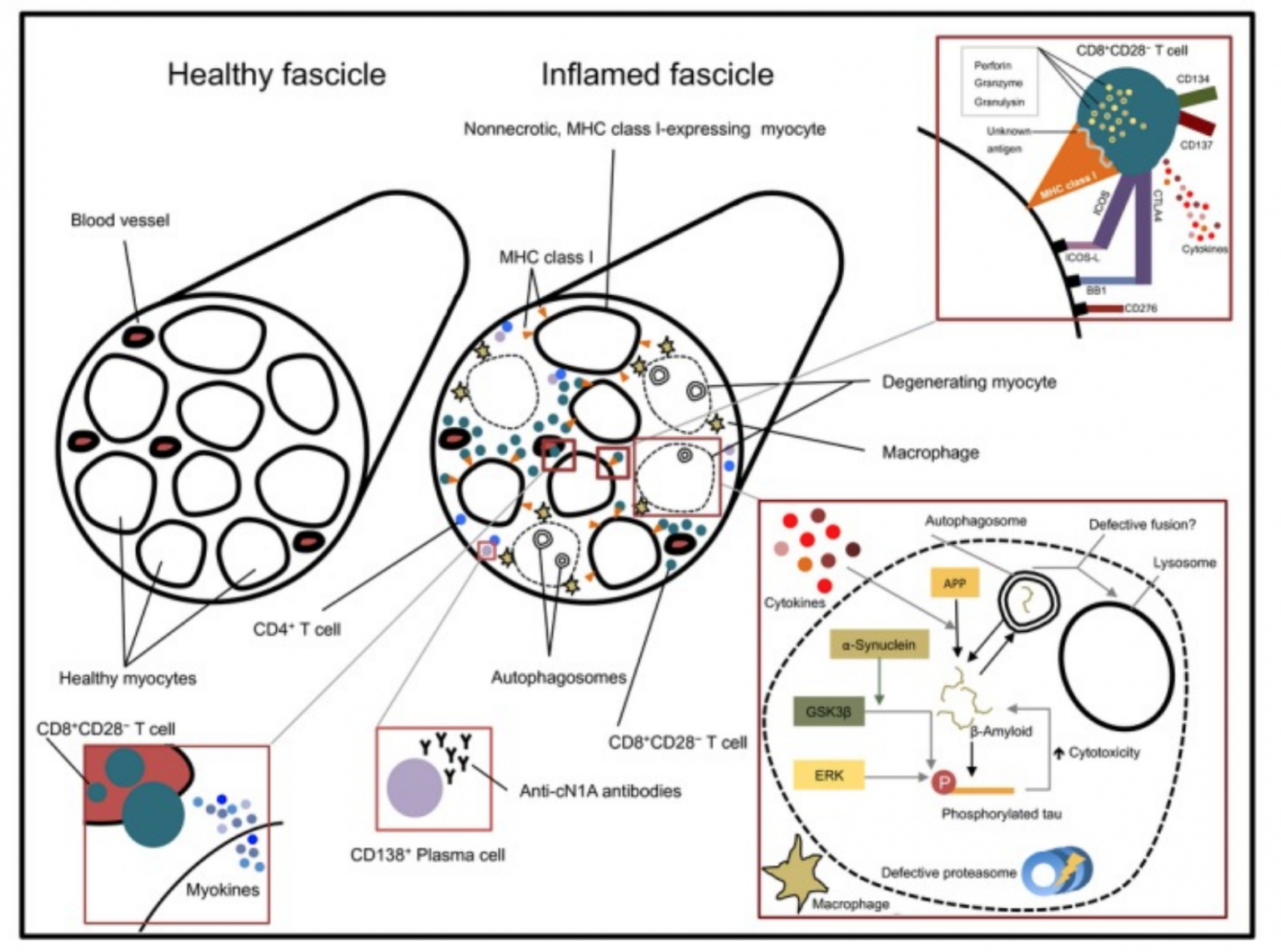 Inclusion Body Myositis: Causes, Genes, And Research