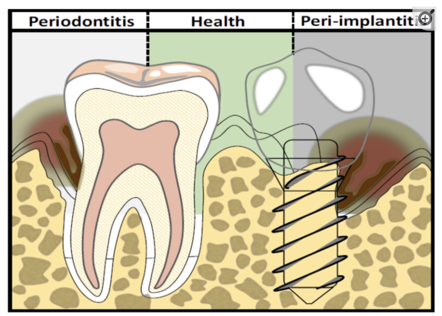 Dental Implants: Genetics & Reducing the Risk of Implant Failures